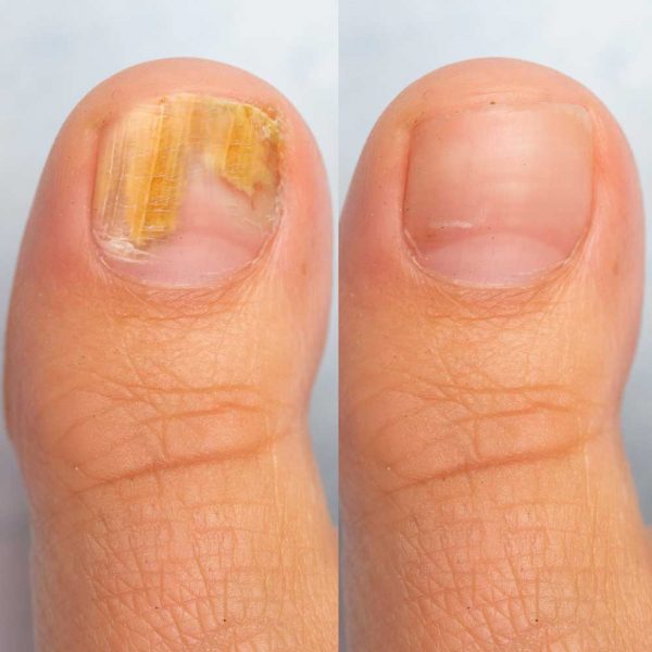 Tratamiento para Hongos Onicomicosis Oniderm Clinica de Uñas